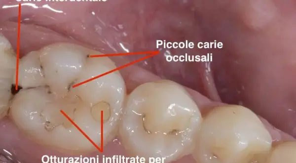 Dente con carie interdentale e piccole carie occlusali. Si nota un puntino nero sul dente, segno di un problema da affrontare.