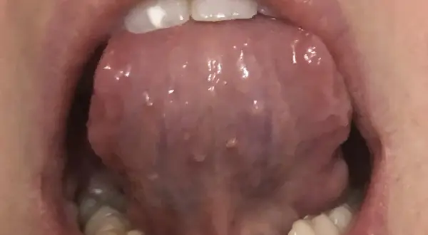 Lingua con piccole protuberanze, forse un papilloma sotto la lingua, visibile con i denti in primo piano.