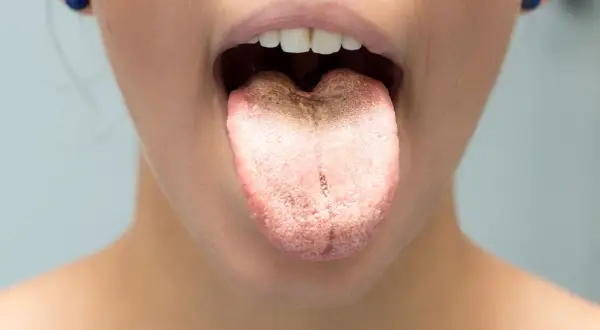 Lingua con patina biancastra e rossastra, possibile sintomo di candida labbra.