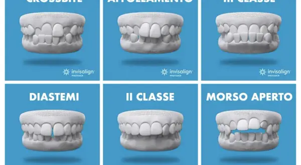 Modelli di denti con problemi: crossbite, affollamento, III classe, diastemi, II classe, morso aperto. Soluzioni Invisalign per correggere.