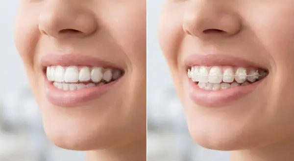 Primo piano di un sorriso con apparecchio trasparente e poi con apparecchio fisso.