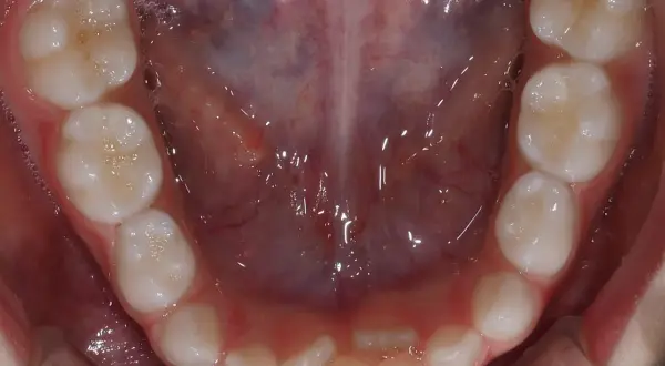 Vista ravvicinata della bocca di un adulto con denti sani, alcuni con piccole bollicine. Si nota una leggera sovrapposizione di alcuni denti, suggerendo una possibile necessità di correzione ortodontica per i denti doppia fila adulti.