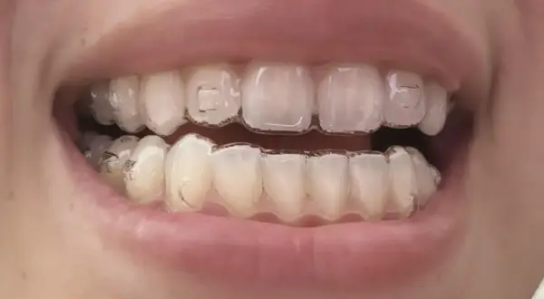 Denti con Invisalign, pronti per mangiare uno yogurt cremoso.