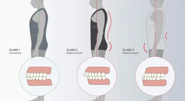 Classi di occlusione dentale: 1 (normale), 2 (malocclusione) e 3 (malocclusione), con profili posturali associati.
