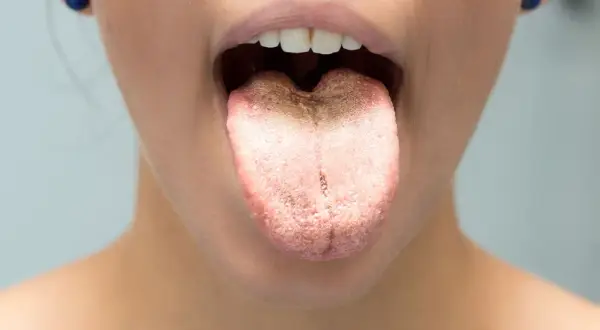 Lingua con patina biancastra, suggerisce sciacqui con bicarbonato per lingua per una pulizia profonda.