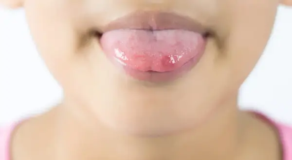 Bocca con lingua arrossata e lesioni, possibili sintomi di stomatite. Le cause possono essere molteplici.