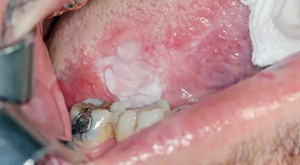 Lesione bianca sulla lingua, in attesa di biopsia escissionale.