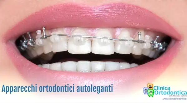 Primo piano di un sorriso con apparecchio autolegante trasparente e metallico.