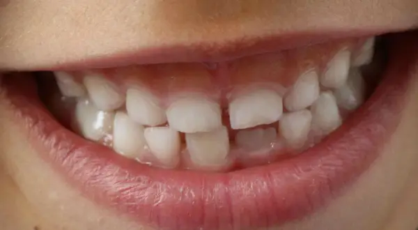 Denti con opacità e striature biancastre, segni di ipomineralizzazione denti, che rendono lo smalto più fragile.