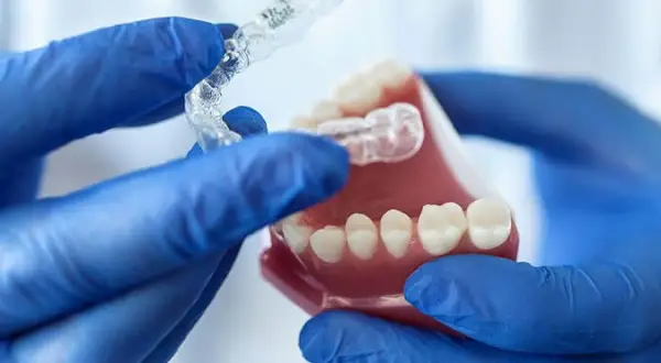 Mani guantate mostrano un bite notturno trasparente su un modello di denti.