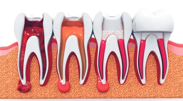 Illustrazione di un dente devitalizzato: dalla polpa infiammata alla sigillatura dei canali radicolari.