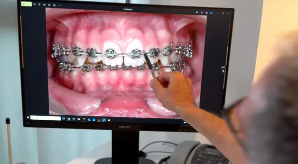 Primo piano di un monitor che mostra un'immagine ravvicinata di denti con apparecchio fisso. Una mano indica l'immagine.