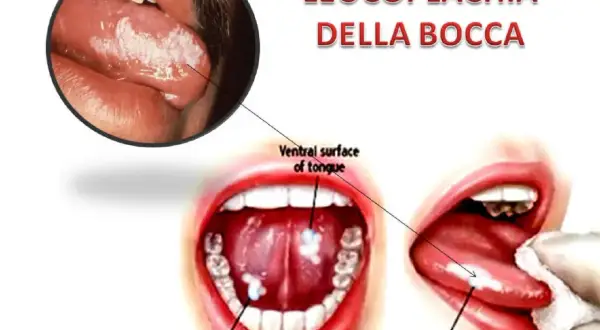 Leucoplachia della bocca: lesioni biancastre su lingua e pavimento orale. Non è una malattia che porta alla morte, ma un segnale da non sottovalutare.