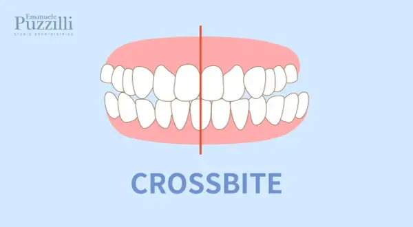Illustrazione di un morso testa a testa, dove i denti superiori coprono quelli inferiori. Il termine "CROSSBITE" è scritto in basso.