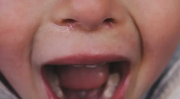 Bocca aperta di un bambino con denti storti da ciuccio, naso umido e labbra rosse.