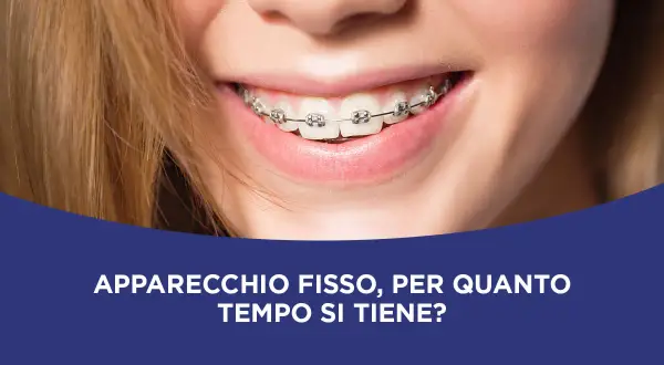 Sorriso di una ragazza con apparecchio fisso. Scopri quanto tempo ci vuole per mettere l'apparecchio e per quanto tempo si tiene.