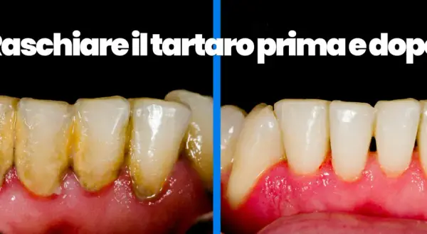 Denti con tartaro prima e dopo la pulizia. Scopri come pulire i denti dal tartaro a casa per un sorriso smagliante.