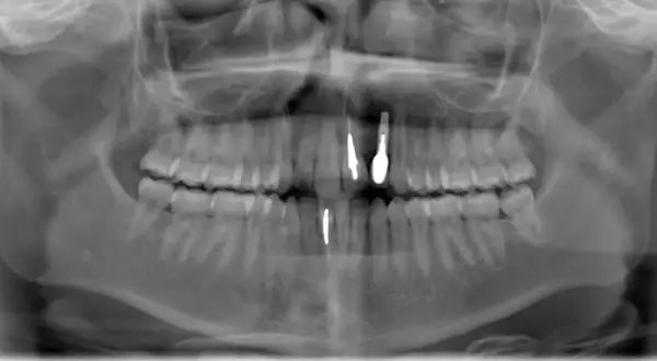Radiografia panoramica dentale che mostra la sinfisi mandibolare con impianti dentali nella mascella e nella mandibola.