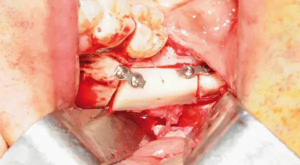 Chirurgia orale: frammento osseo fissato con placche metalliche, vicino al nervo alveolare.