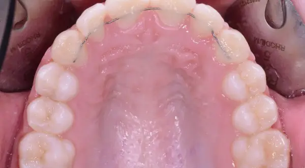Filo contenzione denti: un sottile filo metallico applicato dietro gli incisivi per mantenere l'allineamento. Il costo varia.