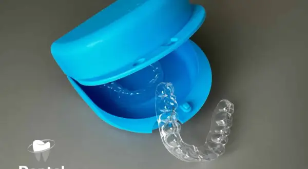 Apparecchio trasparente per correggere la malocclusione 1 classe. Custodia blu aperta con un bite all'interno.
