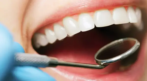Esame del cavo orale con specchietto dentale. Si osservano denti bianchi e gengive sane, escludendo la presenza di stomatite palato.