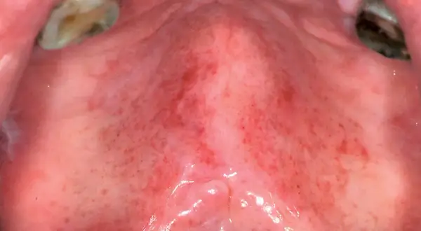 Palato con arrossamento diffuso e numerosi puntini rossi, possibili segni di candida.