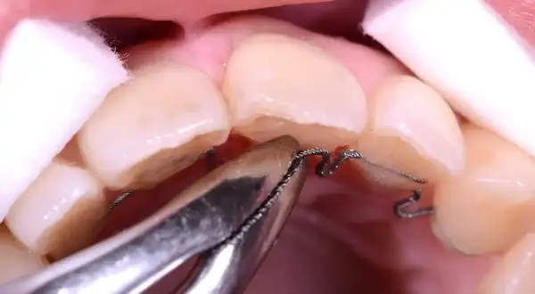 Dettaglio di un apparecchio ortodontico che lavora sullo spazio tra i denti laterali, con cotone per isolare.