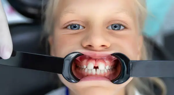 Bambina con diastema, in attesa di apparecchio ortodontico, sorride dal dentista.