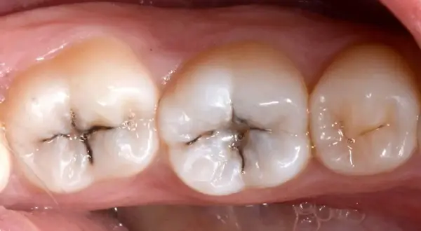 Denti con evidenti segni di carie, con aree scure e profonde che indicano un dente cariato.