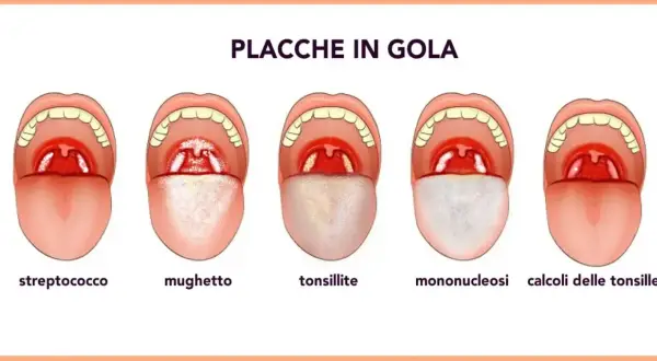Illustrazione di diverse condizioni della gola, tra cui placche, mughetto e tonsillite, utili per comprendere i rimedi naturali per le placche in gola.