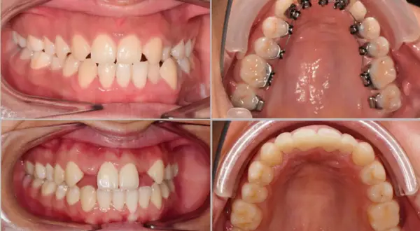 Denti con agenesia e apparecchio ortodontico. Valutare i costi per risolvere l'agenesia dentale.