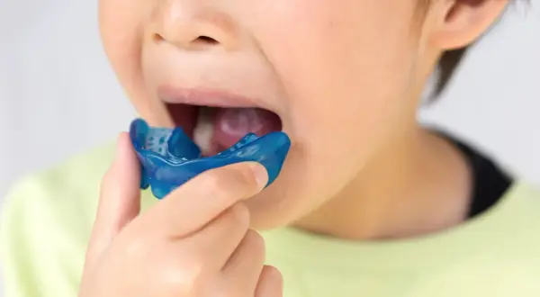 Bambino con apparecchio blu in bocca, parte di un percorso di terapia miofunzionale per migliorare la funzione orale.