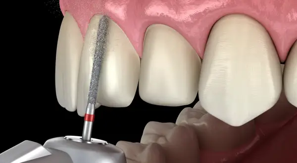 Dettaglio di un dente sottoposto a stripping denti. Considerare le controindicazioni prima di procedere.