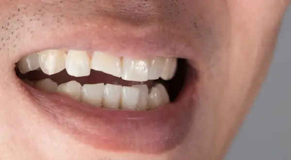 Primo piano di una bocca con un dente bucato lateralmente, mostrando un'evidente carie.