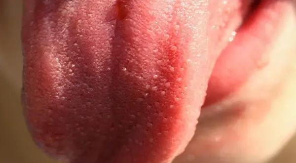 Lingua arrossata con piccole protuberanze e un leggero livido sulla punta, forse dovuto a un morso accidentale.