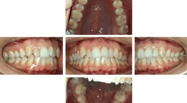 Denti con malocclusione 2 classe, in attesa di trattamento Invisalign.