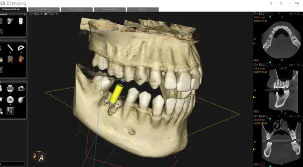Visualizzazione 3D di un impianto dentale tramite cbct dentale. Sezioni assiali, coronali e sagittali mostrano dettagli ossei e dentali.