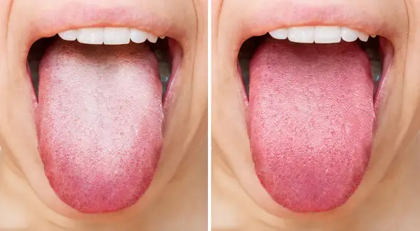 Lingua bianca e patinata prima, rosa e sana dopo. Scopri come pulire la lingua senza vomitare per un alito fresco.