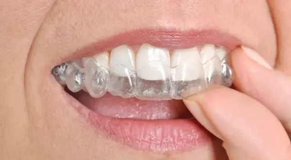 Dita che rimuovono un apparecchio trasparente, mostrando come togliere Invisalign per una pulizia rapida.