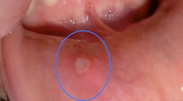 Una piccola afte con filamenti bianchi in bocca, evidenziata da un cerchio blu, appare sulla mucosa interna della guancia.