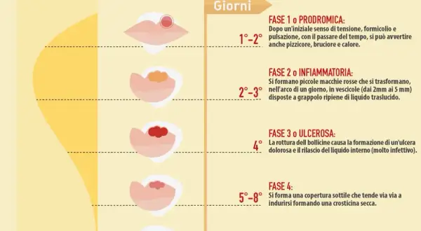 Le fasi dell'herpes labiale: dalla fase prodromica (1-2 giorni) all'ulcera e alla guarigione (fino a 12 giorni).