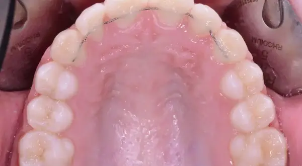 Denti dopo apparecchio con filo metallico di ritenzione. Un sorriso perfetto è il risultato di cure attente.