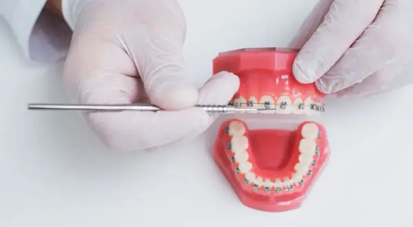 Modello di denti con apparecchio, per correggere denti storti adulti.