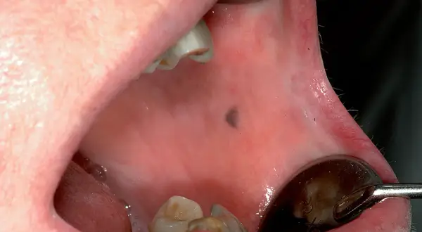 Piccolo neo scuro sulla mucosa interna della guancia, una lesione pigmentata da monitorare.