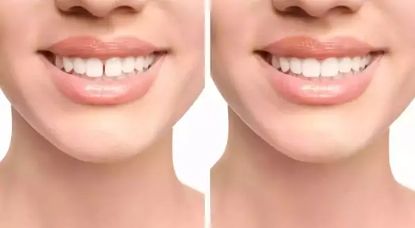 Prima e dopo: il diastema, ovvero lo spazio tra i denti, viene corretto per un sorriso perfetto.