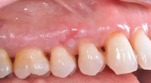 Gengiva con lesione biancastra, possibile leucoplachia villosa, vicino ai denti.