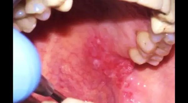 Lingua infiammata con lesioni, strumento medico vicino. La biopsia lingua è dolorosa.