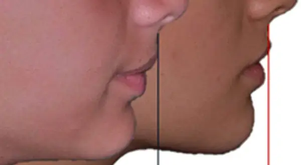 Confronto profili: un morso profondo nel viso evidenziato da linee guida.