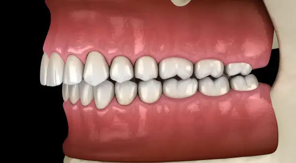 Vista laterale di denti con malocclusione dentale, i denti superiori sporgono notevolmente su quelli inferiori, un sintomo comune.